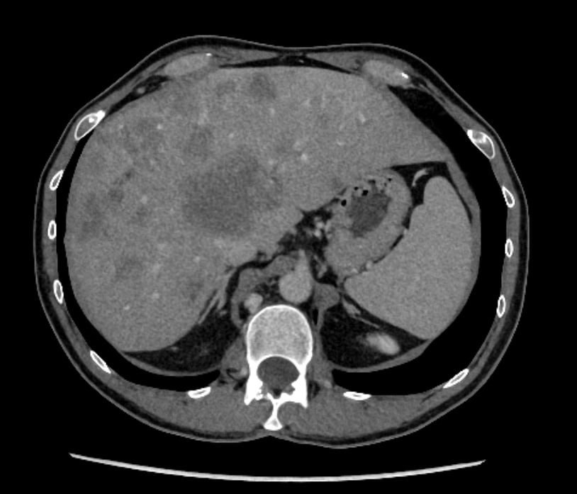 Contrast-enhanced CT scan of the abdomen